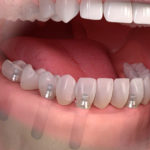 Implantologia tutti i denti fissi