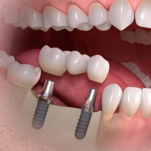 Implantologia su più denti