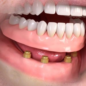 Implantologia a Empoli - Tutti i denti removibili